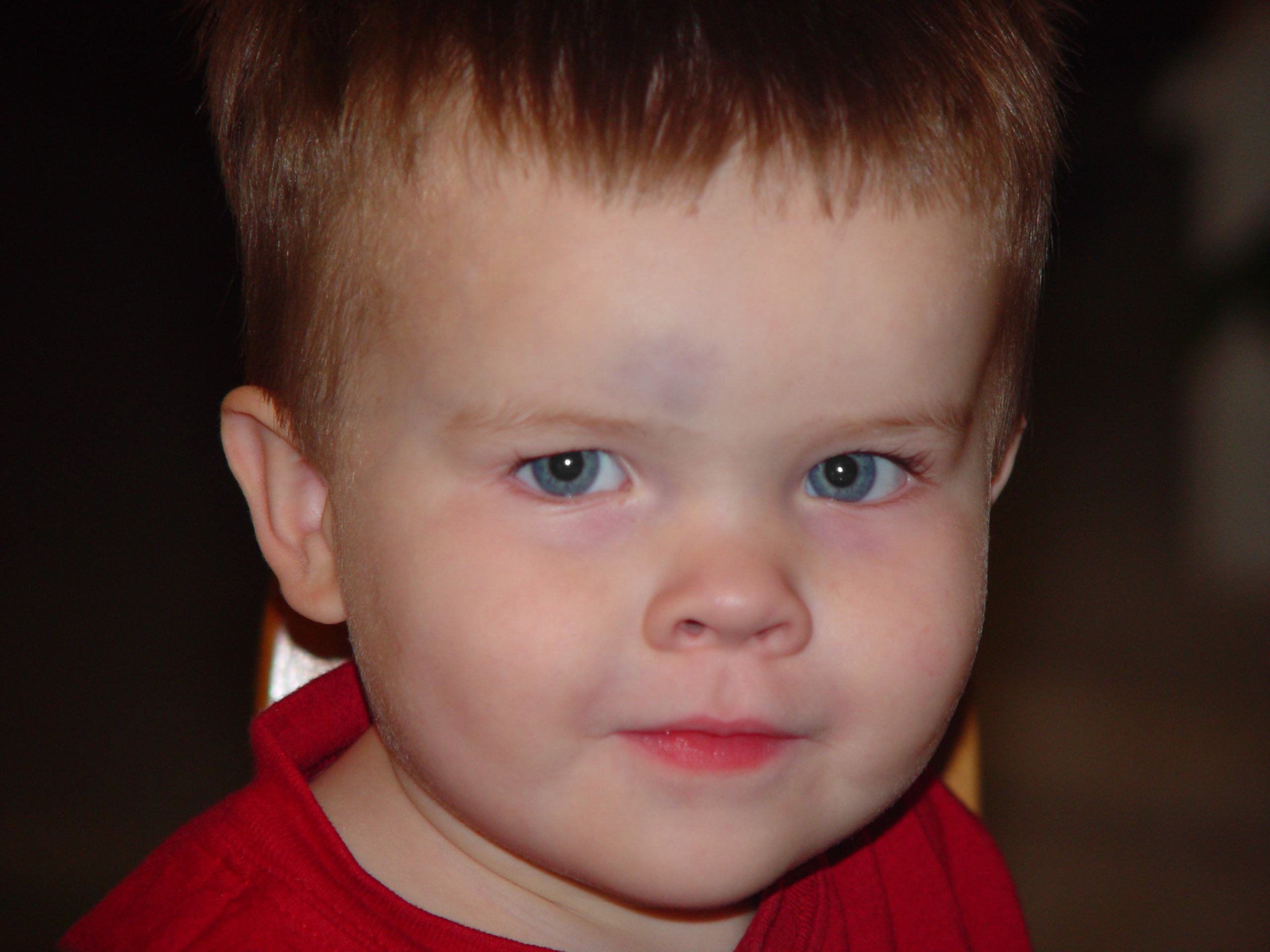 Zack's 1st Black Eye, Easter 2005